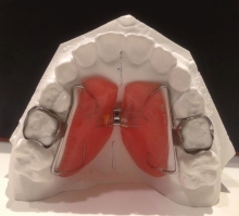 矯正装置解説コーナー 霧島市 みやかわ小児矯正歯科 スマホ版