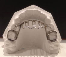 矯正装置解説コーナー 霧島市 みやかわ小児矯正歯科 スマホ版